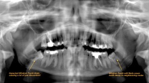 Wisdom teeth removal xray: arrows point to wisdom teeth extraction areas, procedure is recommended at a younger age