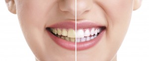 Teeth Whitening can offer a dramatic improvement for patients who have significant tooth staining or discolouration