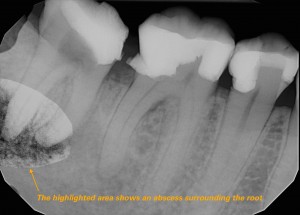 The highlighted tooth shows an abscess surrounding the root. A root canal is necessary to prevent more additional infection.
