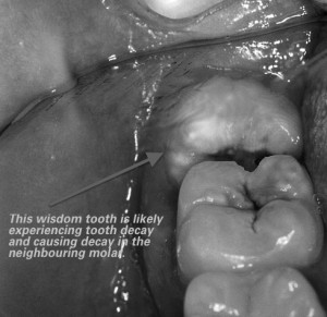 Erupted wisdom tooth - when wisdom teeth removal is necessary