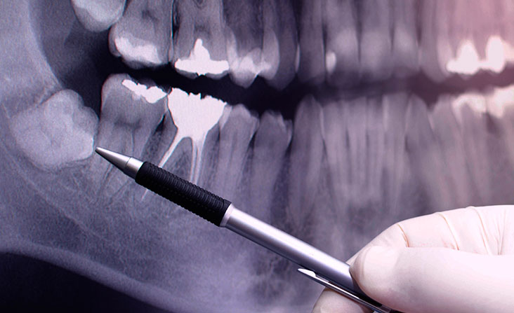 Wisdom teeth removal Vancouver - Dentist showing impacted wisdom tooth on dental x-ray image. Wisdom teeth removal kitsilano