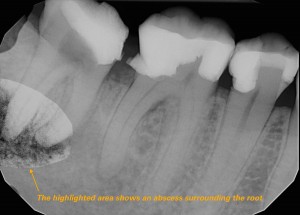 Root Canal Vancouver: The highlighted tooth shows an abscess surrounding the root. A root canal is necessary to prevent more additional infection. 