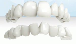 Invisalign animation of teeth being aligned over time.