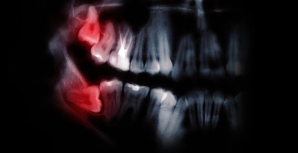 Wisdom Teeth Removal Vancouver - Image of teeth x-ray with lighting effects. Wisdom teeth removal Kitsilano