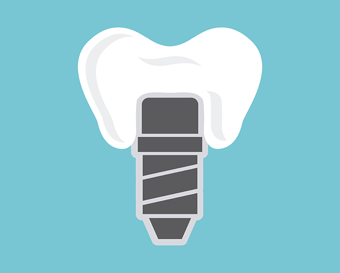 dental implants design | Vancouver dentist